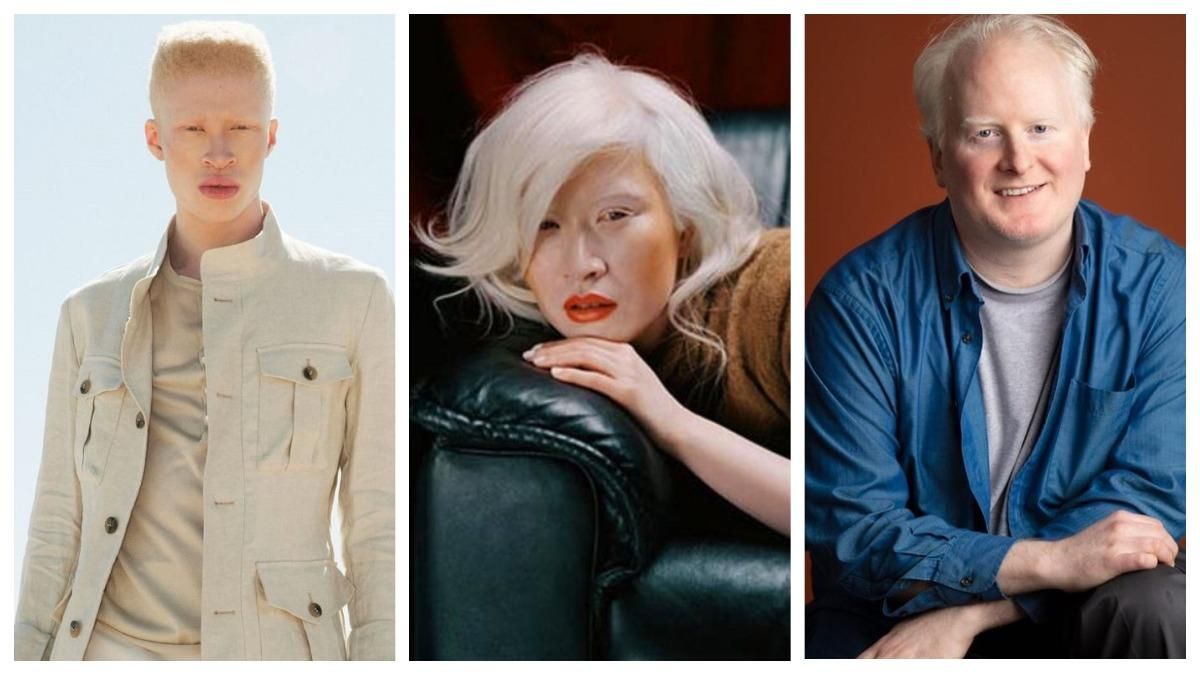 Сильні незважаючи ні на що: відомі люди, які живуть з альбінізмом Сильні незважаючи ні на що: відомі люди, які живуть з альбінізмом