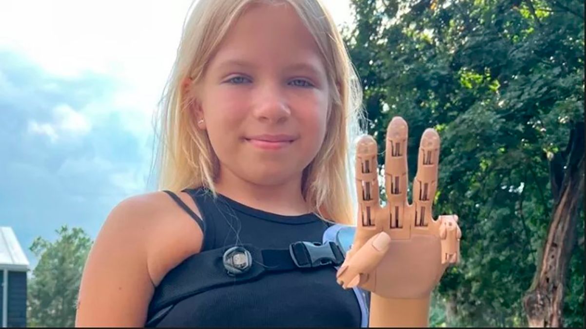 9-летняя Саша из Гостомеля получила новую руку - как она впервые по ней двигает - видео