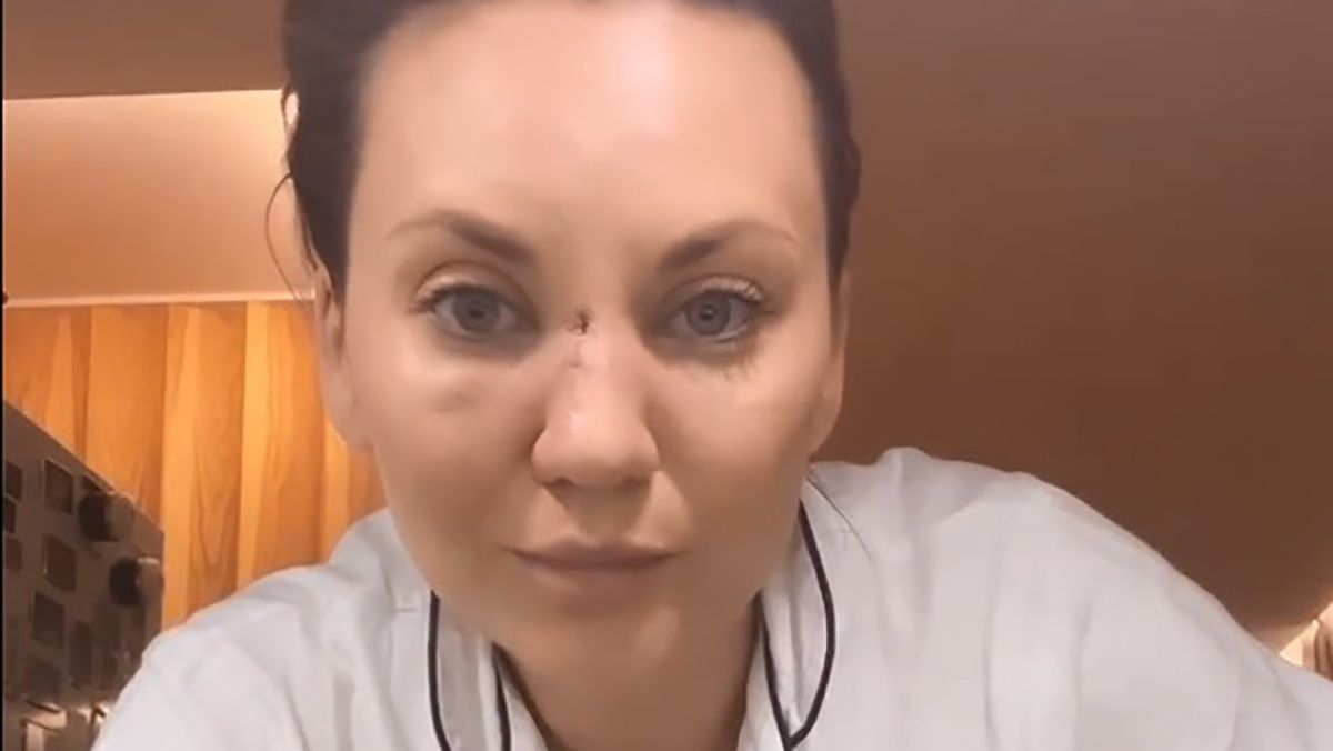 Анна Саліванчук послизнулася та зламала ніс – як вона виглядає – фото Анна Саліванчук послизнулася та зламала ніс – як вона виглядає – фото