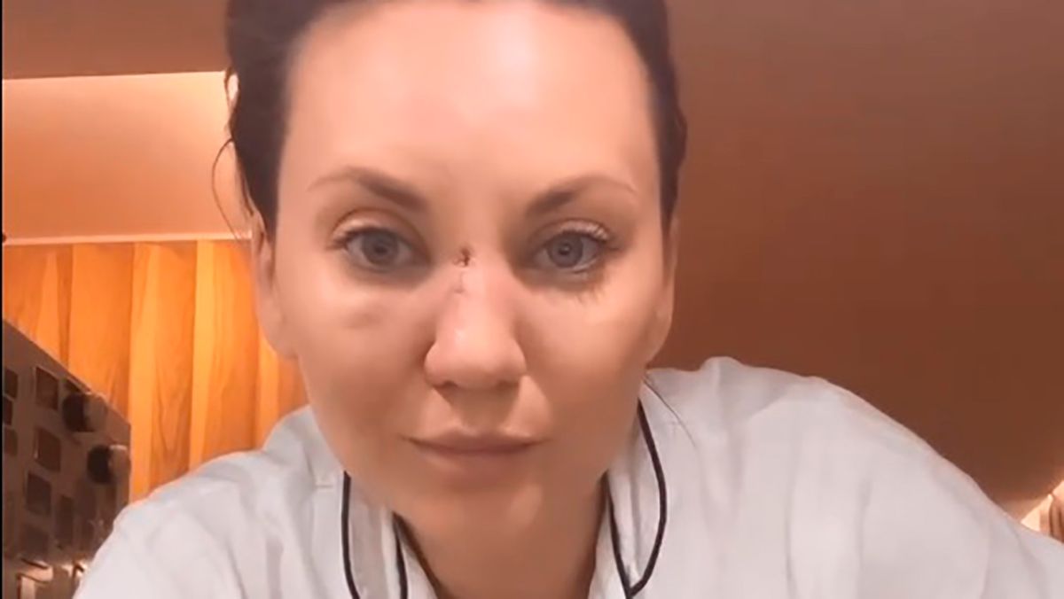 Анна Саливанчук поскользнулась и сломала нос – как она выглядит – фото