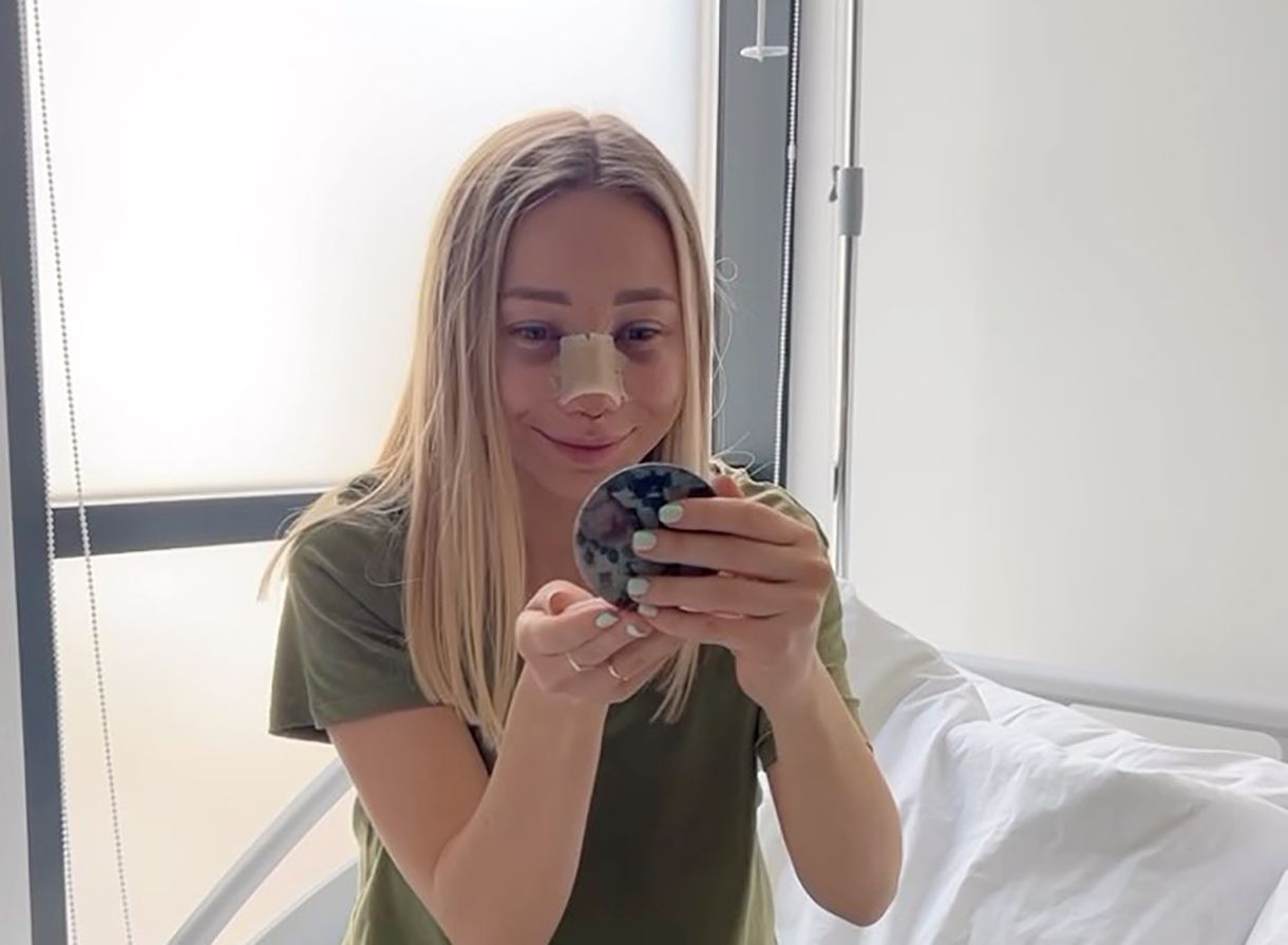 Екатерина Репьяхова сделала ринопластику Екатерина Репьяхова сделала ринопластику