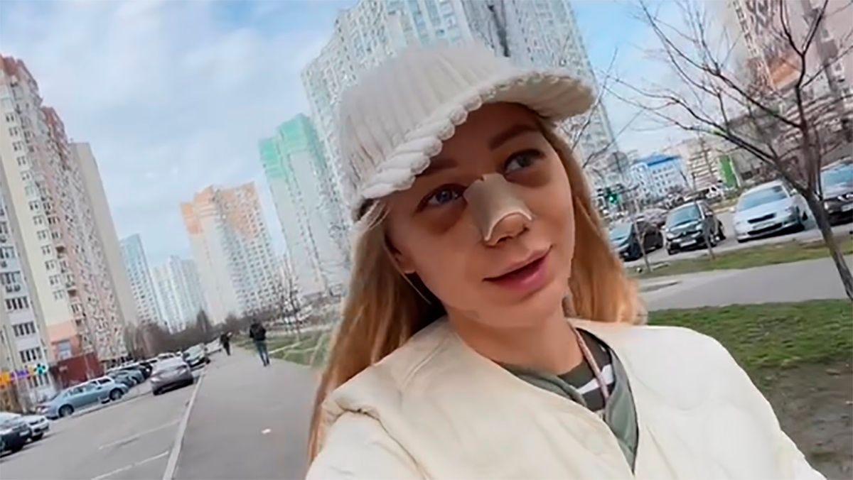 Дружина Павліка зробила операцію на носі – як на неї реагують люди – кумедна реакція Дружина Павліка зробила операцію на носі – як на неї реагують люди – кумедна реакція